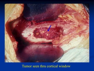 Tumor seen thru cortical window
 