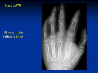 Case #579




10 year male
Ollier’s hand
 