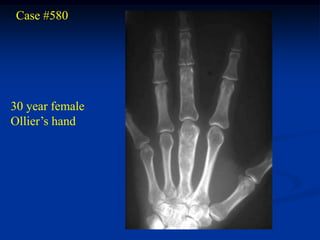 Case #580




30 year female
Ollier’s hand
 