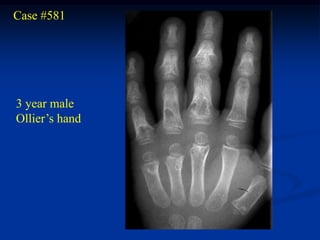 Case #581




3 year male
Ollier’s hand
 