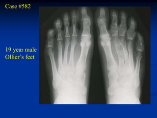 Case #582




19 year male
Ollier’s feet
 
