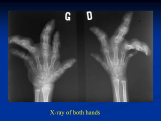 X-ray of both hands
 