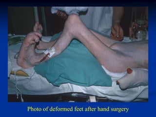 Photo of deformed feet after hand surgery
 