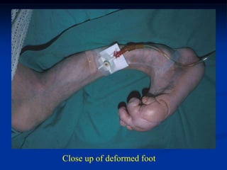 Close up of deformed foot
 