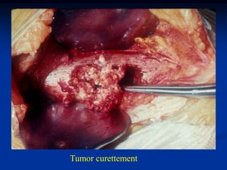 Tumor curettement
 