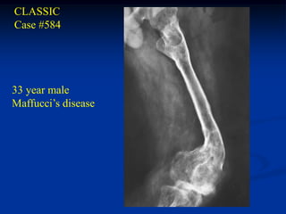 CLASSIC
Case #584




33 year male
Maffucci’s disease
 