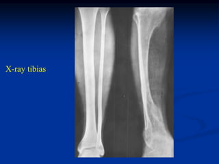 X-ray tibias
 