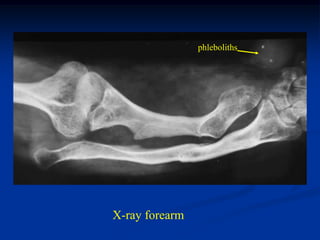 phleboliths


            phleboliths




X-ray forearm
 