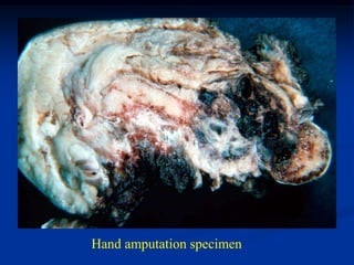 Hand amputation specimen
 