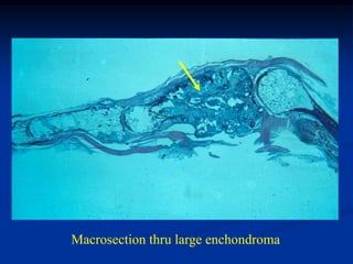 Macrosection thru large enchondroma
 