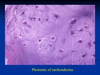 Photomic of enchondroma
 