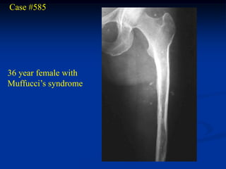 Case #585




36 year female with
Muffucci’s syndrome
 