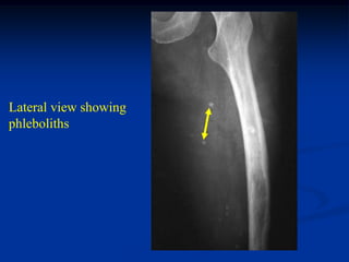 Lateral view showing
phleboliths
 