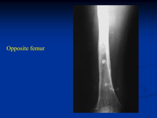 Opposite femur
 