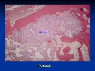 tumor




Photomic
 
