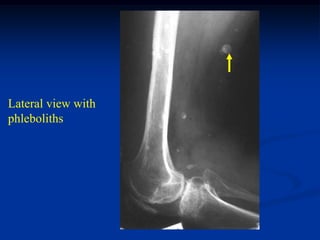 Lateral view with
phleboliths
 