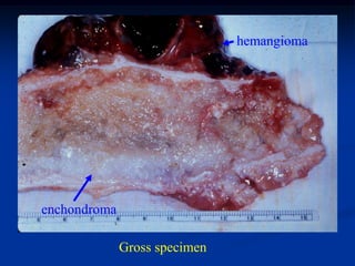 hemangioma




enchondroma

              Gross specimen
 