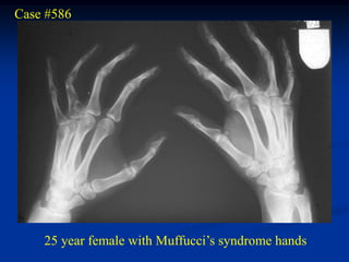 Case #586




    25 year female with Muffucci’s syndrome hands
 