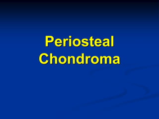 Periosteal
Chondroma
 