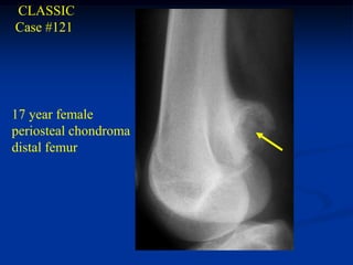 CLASSIC
Case #121




17 year female
periosteal chondroma
distal femur
 