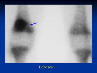 Bone scan
 