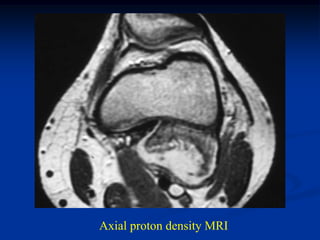 Axial proton density MRI
 