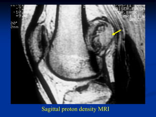 Sagittal proton density MRI
 
