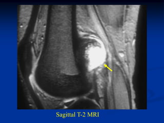 Sagittal T-2 MRI
 