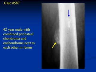 Case #587




42 year male with
combined periosteal
chondroma and
enchondroma next to
each other in femur
 