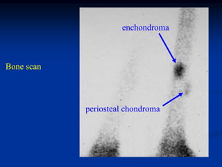 enchondroma



Bone scan



            periosteal chondroma
 