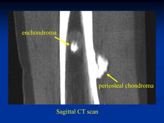 enchondroma




                             periosteal chondroma



          Sagittal CT scan
 