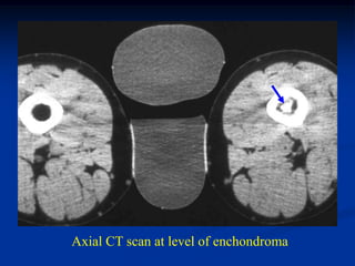 Axial CT scan at level of enchondroma
 