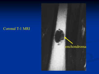 Coronal T-1 MRI



                  enchondroma
 