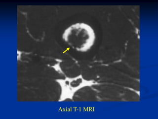 Axial T-1 MRI
 