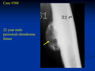 Case #588




22 year male
periosteal chondroma
femur
 
