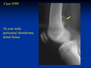 Case #589




16 year male
periosteal chondroma
distal femur
 