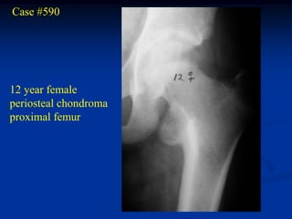 Case #590




12 year female
periosteal chondroma
proximal femur
 
