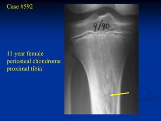 Case #592




11 year female
periosteal chondroma
proximal tibia
 