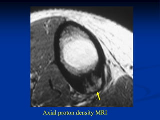 Axial proton density MRI
 