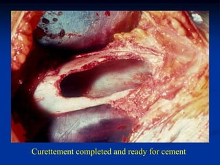 Curettement completed and ready for cement
 