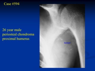 Case #594




26 year male
periosteal chondroma
proximal humerus
                       tumor
                           tumor
 