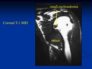 small enchondroma



Coronal T-1 MRI



                  tumor
 