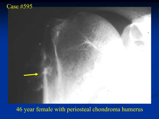 Case #595




   46 year female with periosteal chondroma humerus
 
