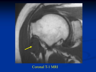 Coronal T-1 MRI
 