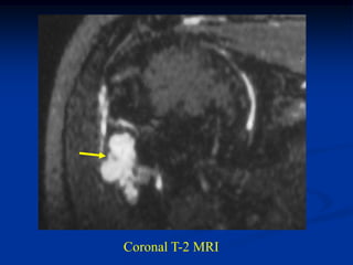 Coronal T-2 MRI
 