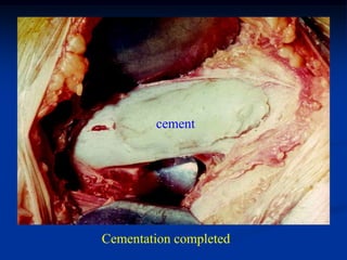 cement




Cementation completed
 