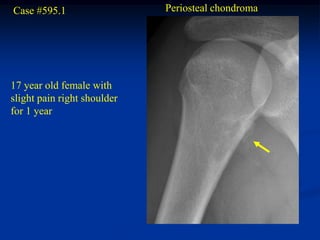 Case #595.1                  Periosteal chondroma




17 year old female with
slight pain right shoulder
for 1 year
 
