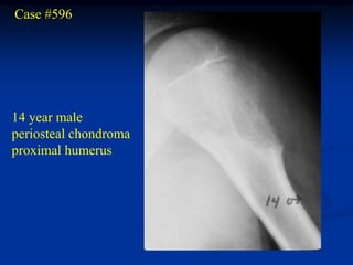 Case #596




14 year male
periosteal chondroma
proximal humerus
 