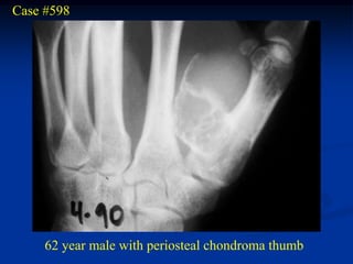 Case #598




     62 year male with periosteal chondroma thumb
 