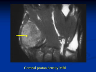 Coronal proton density MRI
 